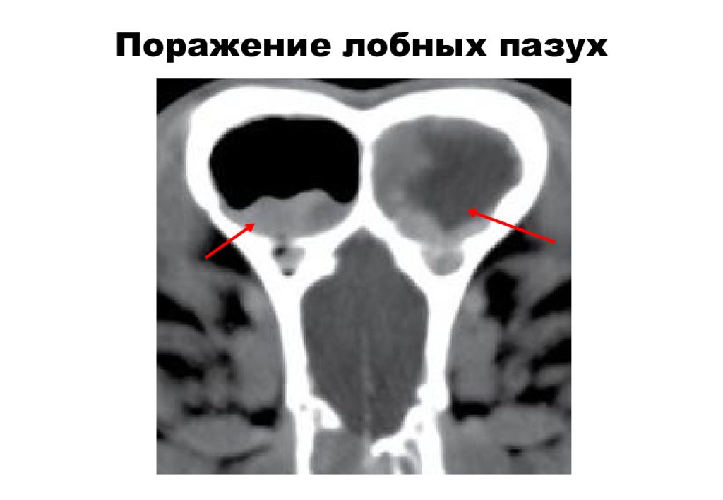 Аплазия лобной пазухи: причины, симптомы и лечение