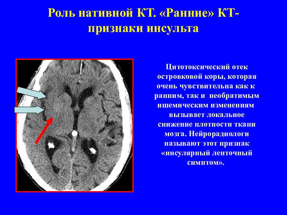 Кт признаки. Плотность ишемического инсульта на кт. Цитотоксический отек мозга кт. Цитотоксический отек мозга мрт. Плотность при ишемическом инсульте на кт.