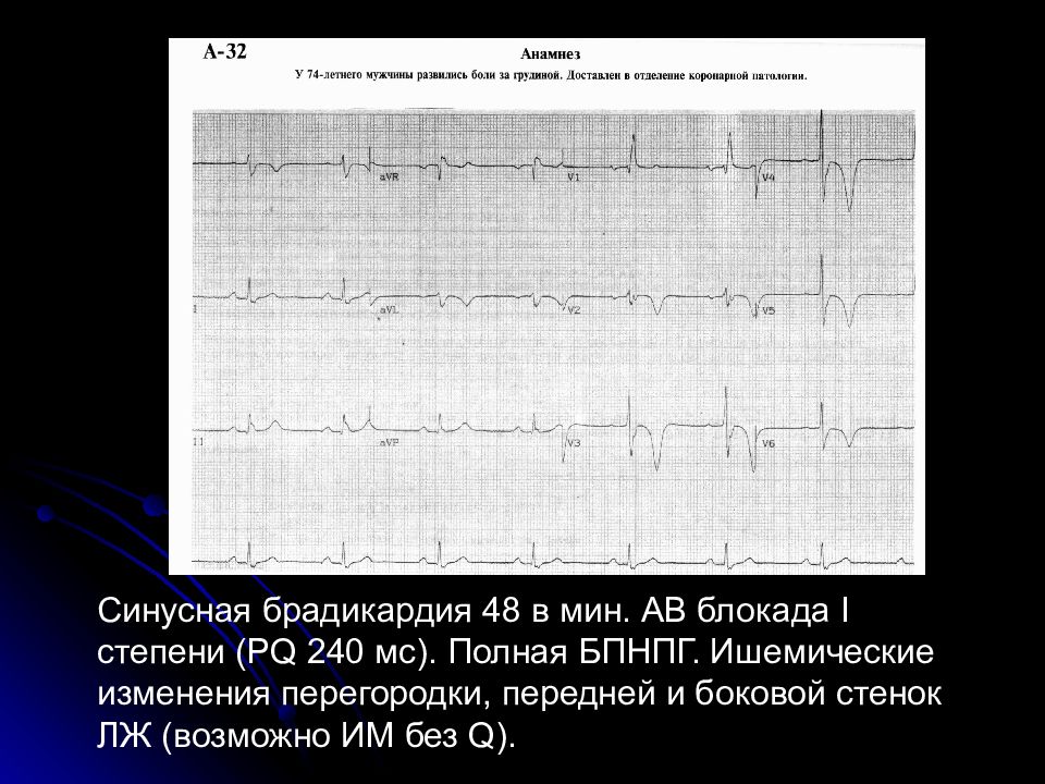 Блокада том 1. АВ блокада брадикардия. АВ блокада 1 степени PQ. Синдромы АВ блокады. PQ при АВ блокада 1 степени.