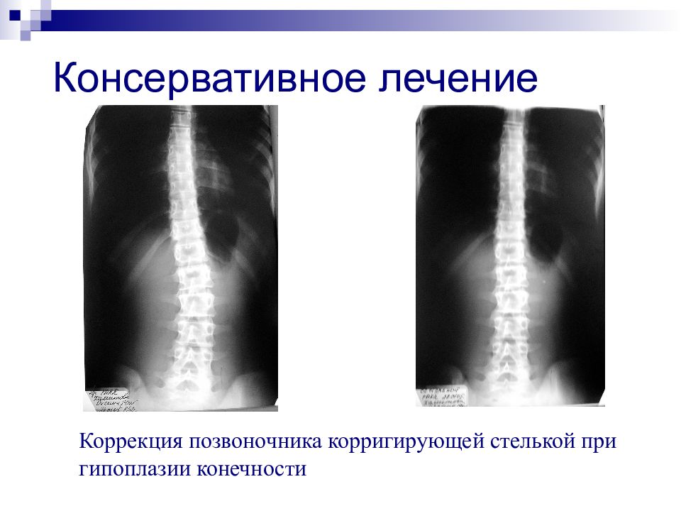 Сколиотическая болезнь травматология и ортопедия презентация