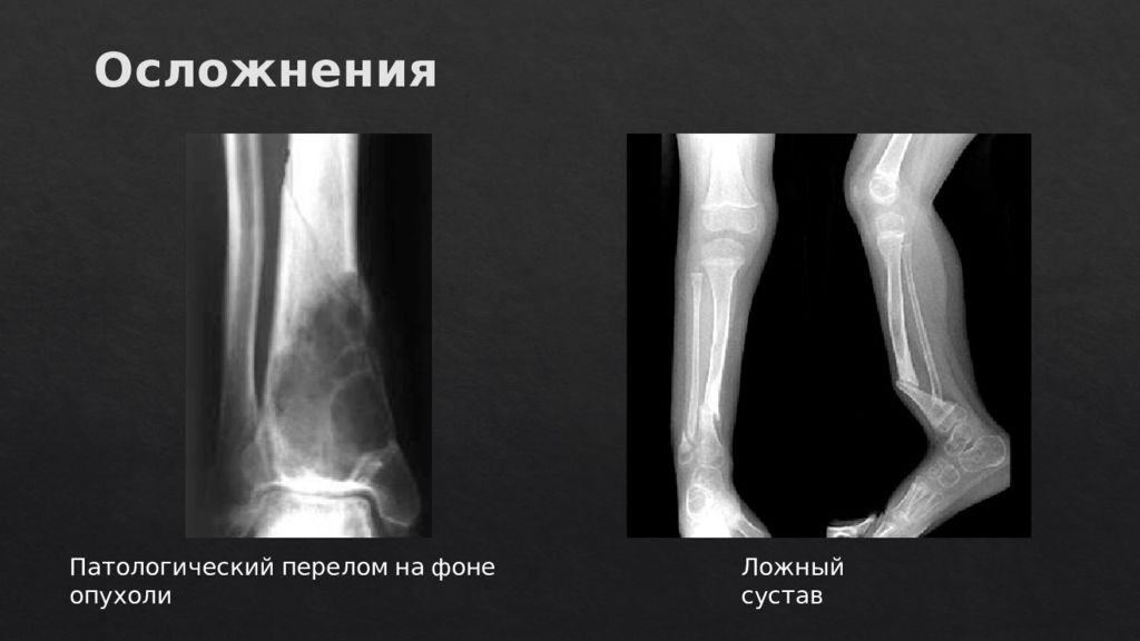 Патологический перелом. Патологический перелом рентген. Патологические переломы костей. Патологический перелом кости. Травматические и патологические переломы.