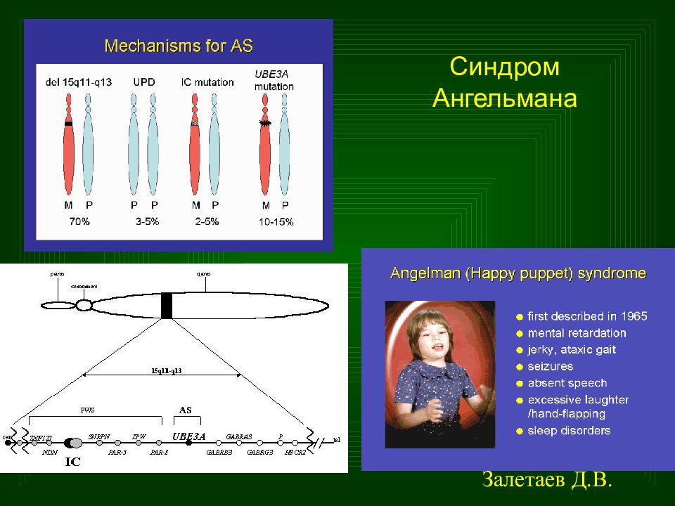 Синдром ангельмана презентация по генетике