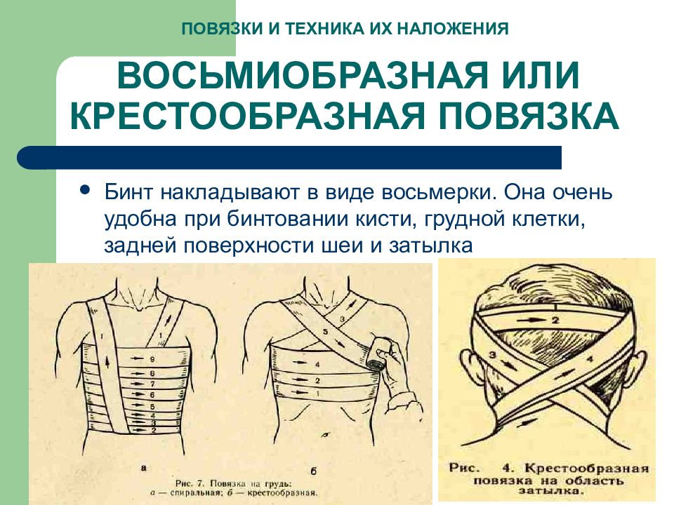 Десмургия виды повязок презентация