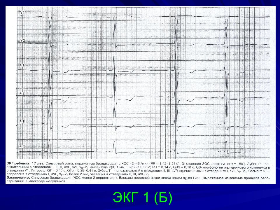 Брадиаритмия у ребенка. Синусовая брадиаритмия на ЭКГ. ЭКГ при брадиаритмии. Брадиаритмия на ЭКГ У ребенка. Синусовая брадиаритмия сердца что это такое у детей.