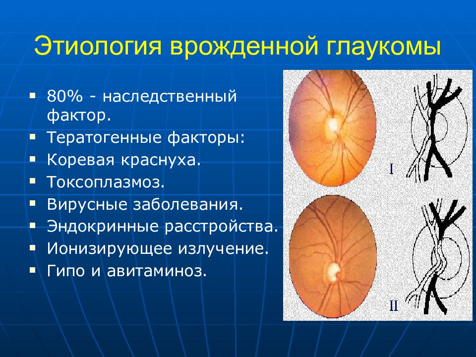 Врожденная глаукома презентация