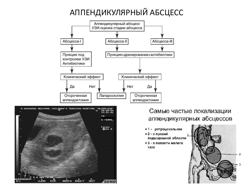 Перитонит у детей презентация