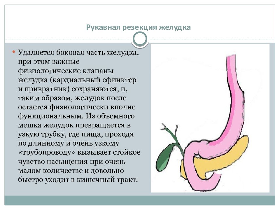 Удаление желудка. Рукавная резекция желудка. Продольная (рукавная) резекция желудка. Парциальная резекция желудка.