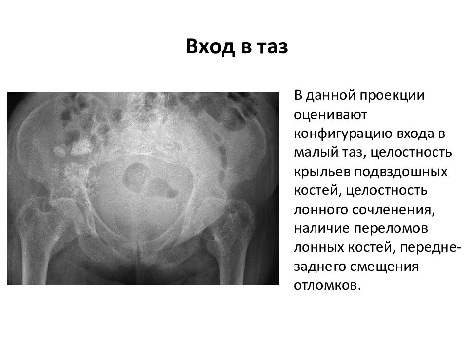 Кости лонного сочленения. Перелом лонного сочленения таза. Перелом лонной кости код по мкб 10. Перелом лонной кости мкб.