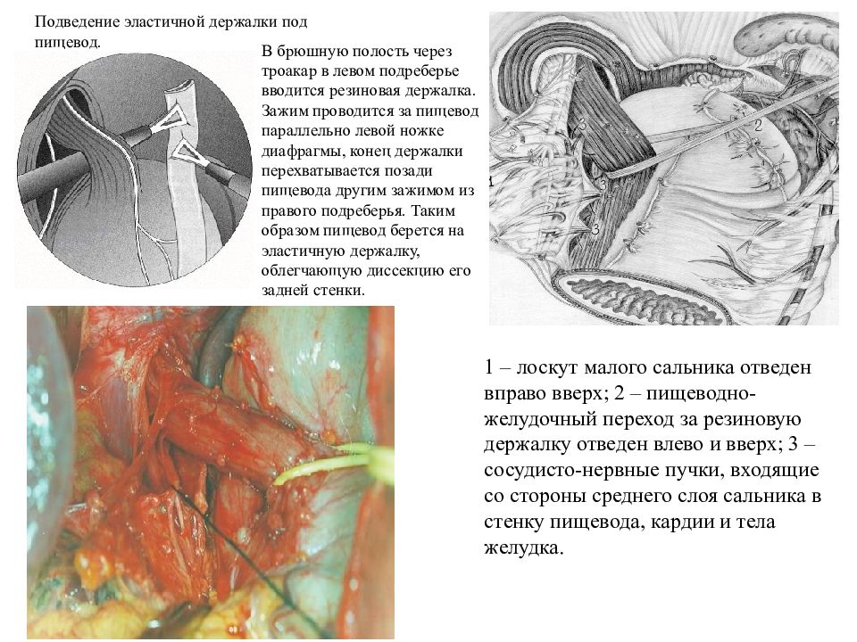 Диафрагмальные грыжи презентация хирургия