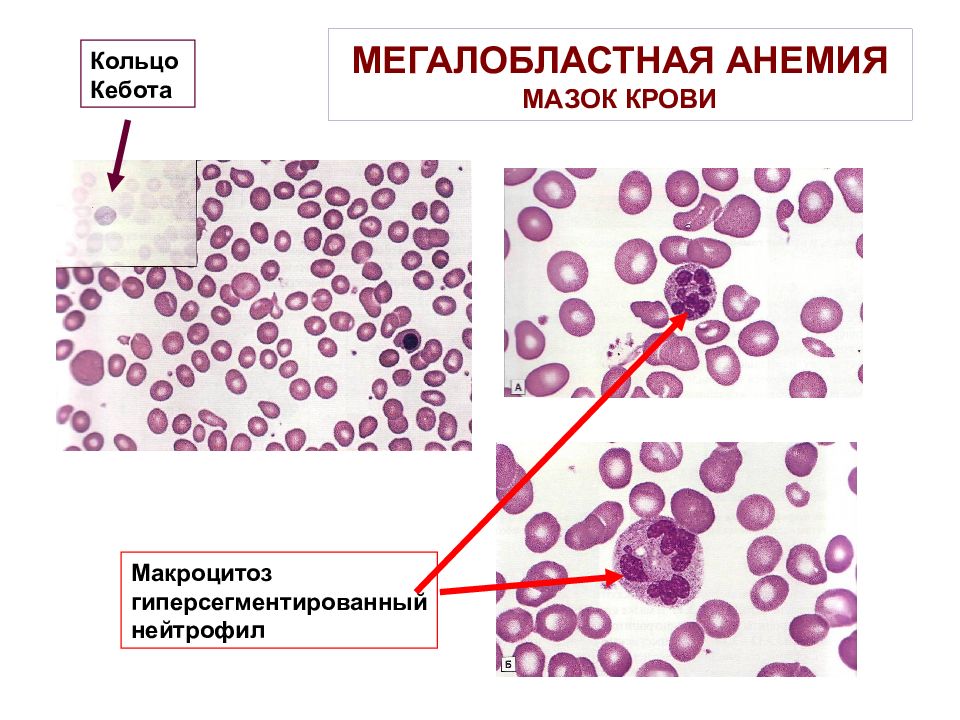 Мегалобластная анемия презентация