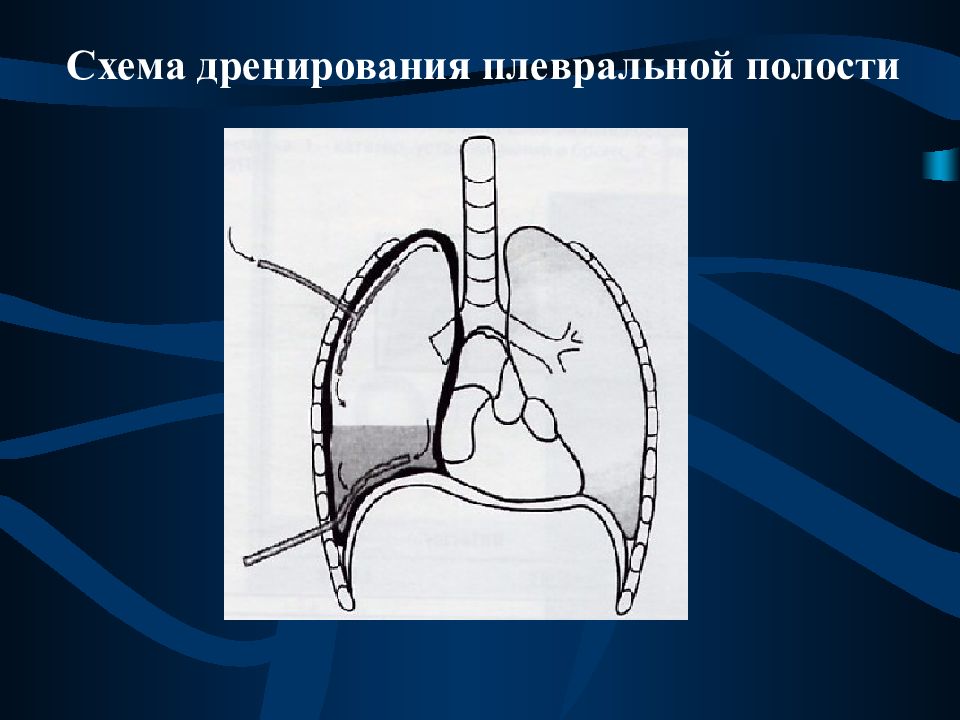 Дренирование плевральной полости. Схема дренирования плевральной полости. Плевральная полость схема. Патология плевральной полости. Показания к дренированию плевральной полости.