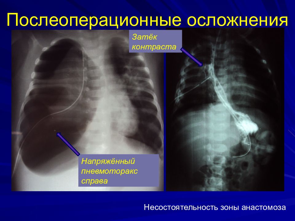 Впр пищевода