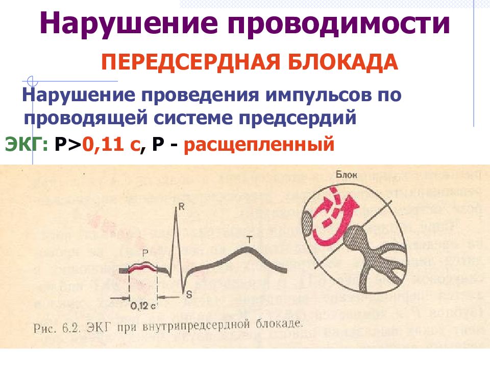 Внутрижелудочковые нарушения экг. Нарушение проводимости на ЭКГ. Нарушение предсердной проводимости. Нарушение проведения импульса по проводящей системе предсердий. Нарушение проводимости предсердий на ЭКГ.