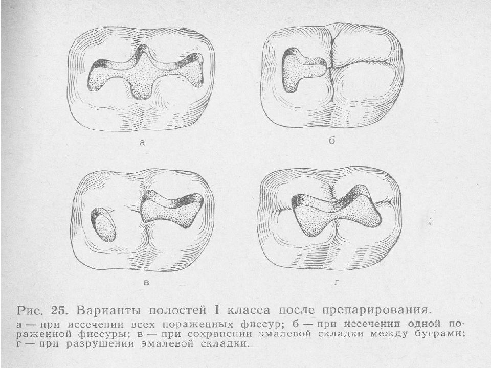 Препарирование 4 класса по блэку. 2 Класс по Блэку в стоматологии. Препарирование 5 класса по Блэку. Классы по Блэку в стоматологии в картинках. Класс по Блэку в стоматологии.