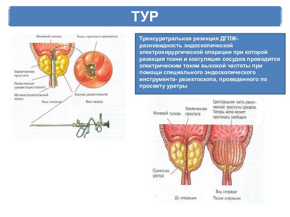 Предстательная железа последствия операции. Трансуретральная резекция ДГПЖ. Трансуретральная резекция гиперплазии простаты. Операция при аденоме предстательной железы. Трансуретральная резекция аденомы предстательной железы.