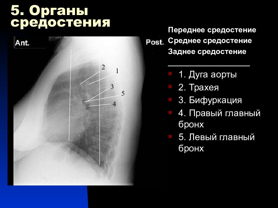 Рентгенограмма в боковой проекции. Рентгеноанатомия грудной клетки. Анатомия средостения рентген. Органы средостения рентген анатомия.