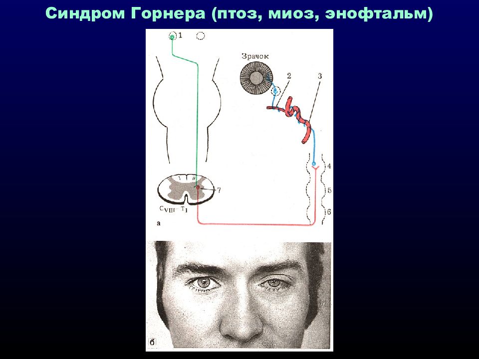 Синдром клода бернара горнера. Триада Бернара горнера. Симптом Бернара горнера.