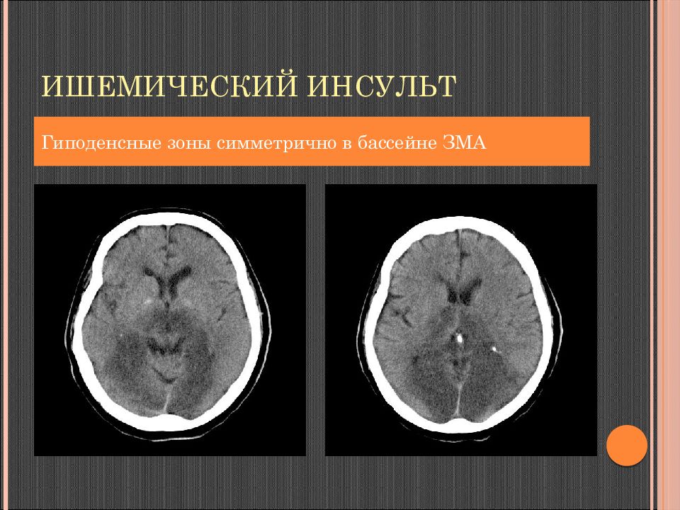 Ишемический инсульт. Ишемический инсульт гиподенсная зона. ОНМК В вертебробазилярном бассейне на кт. Ишемический инсульт кт. Ишемический инсульт в зма.