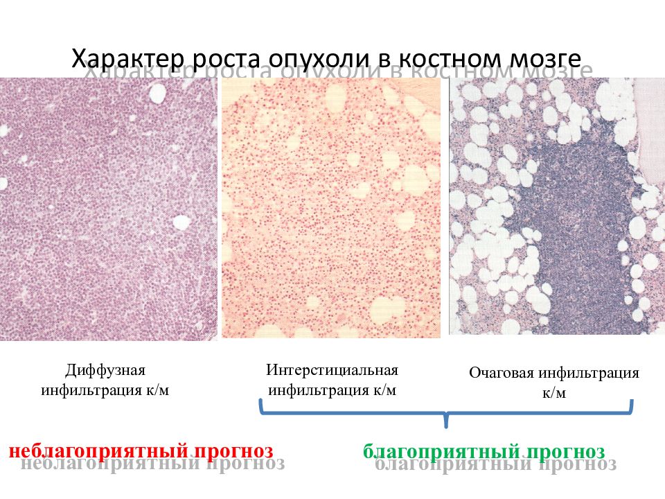 Характер роста. Диффузная инфильтрация гистология. Лейкозная инфильтрация костного мозга. Опухолевая инфильтрация костного мозга. Очаговая инфильтрация костного мозга.