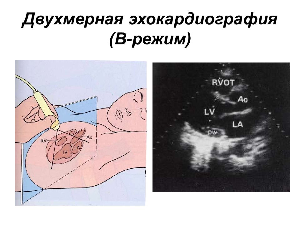 Режим б. Двухмерная эхокардиография (в - режим). Одномерная ЭХОКГ. Одномерная эхокардиография. Режимы ЭХОКГ.