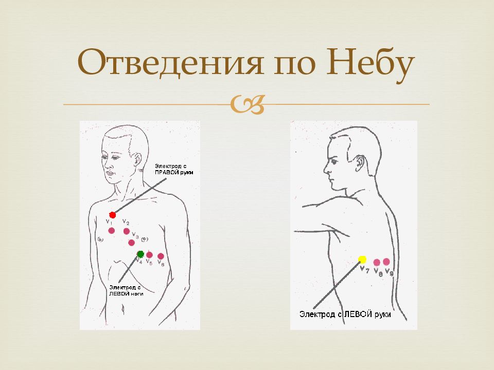 Правые грудные. Электроды v7 v8 v9. Дополнительные отведения v7 v 8. Наложение электродов v7-v9. Дополнительные отведения ЭКГ v7 v8 v9 расположение.