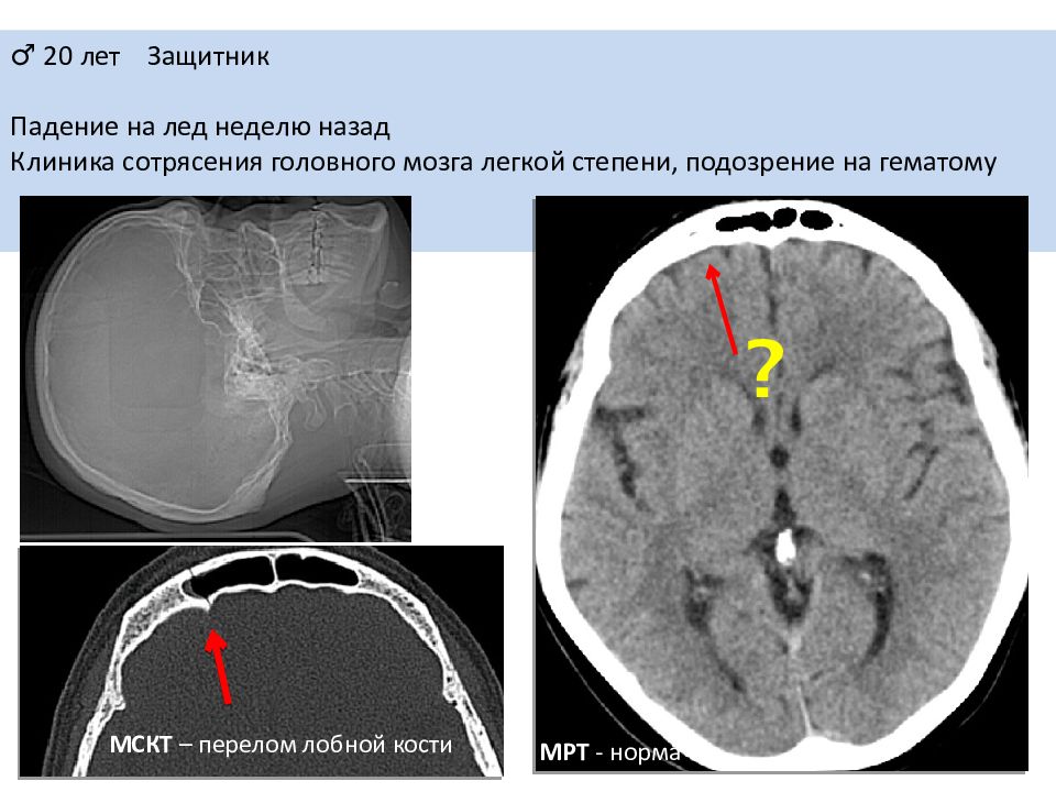 Кт при сотрясении головного мозга