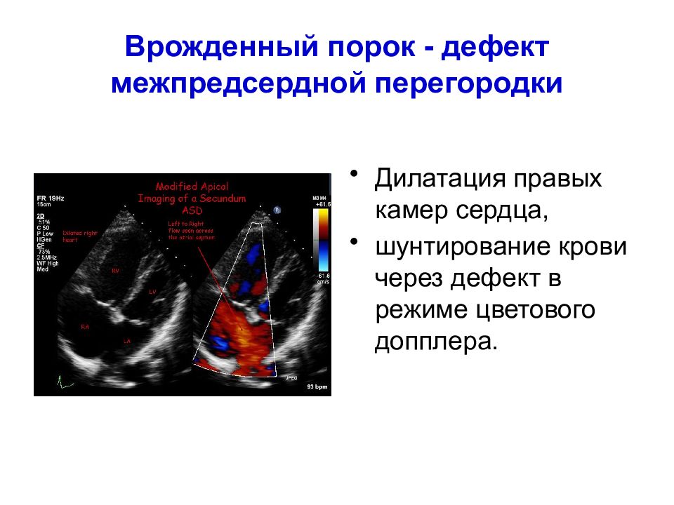 Дефект межпредсердной. Пороки межпредсердной перегородки ЭХОКГ. Дефект межпредсердной перегородки на ЭХОКГ. Врожденный порок сердца дефект межпредсердной перегородки.