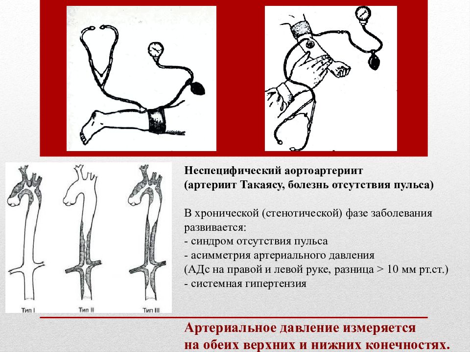 Неспецифический аортоартериит презентация