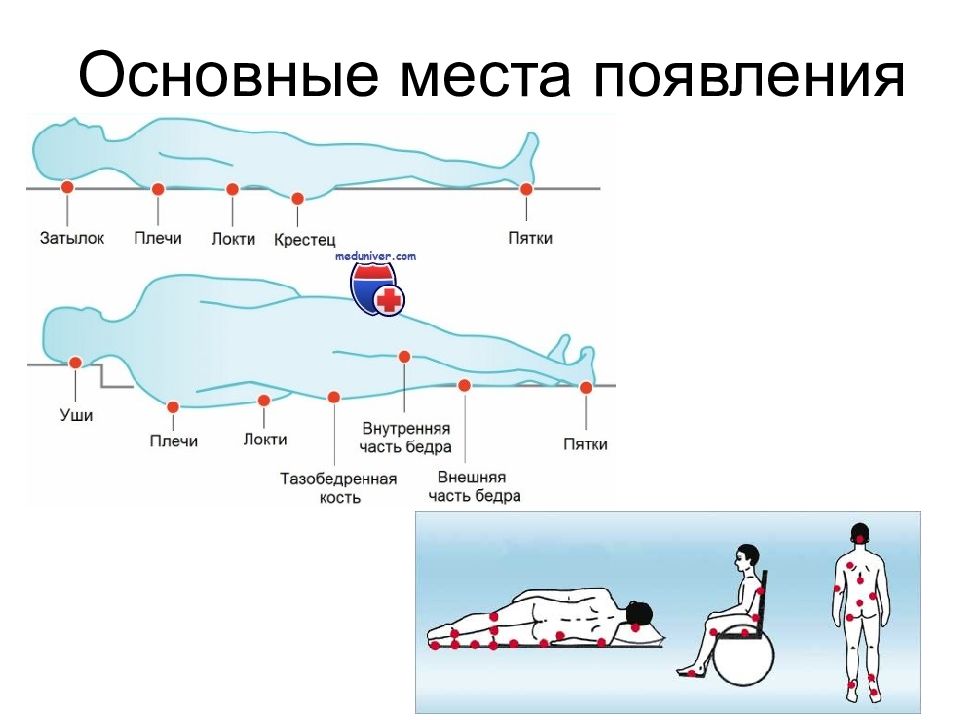 Карта пролежней заполненная