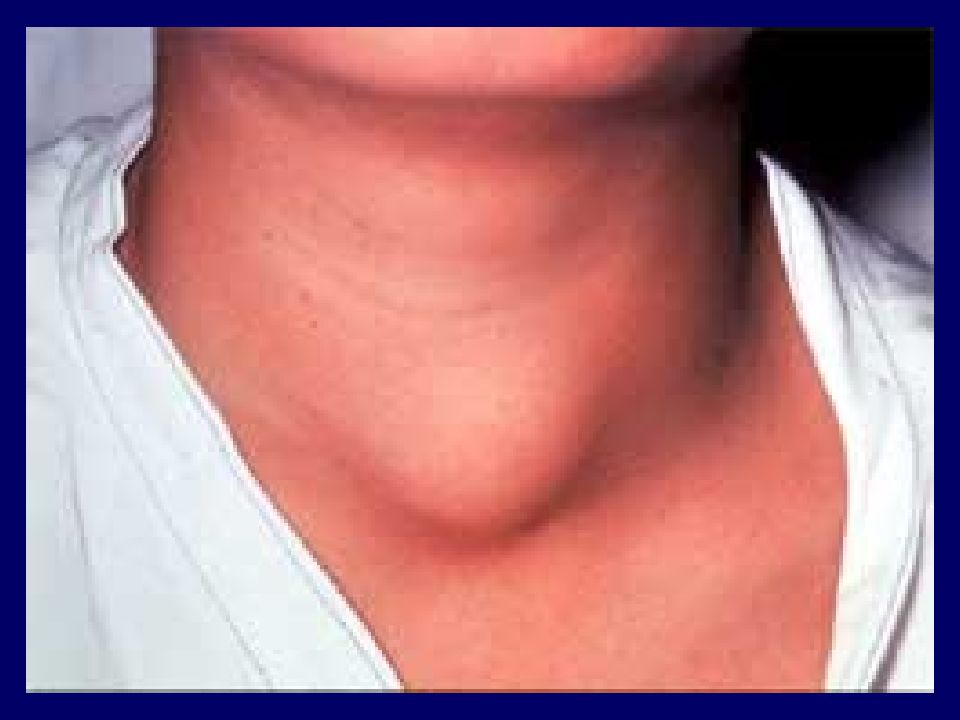 Зоб ахан. Зобная железа щитовидка. Тиреоидит воспаление щитовидной. АИТ зоб щитовидной железы.