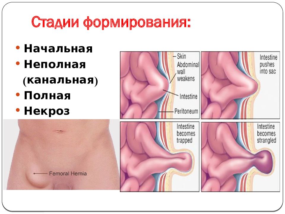 Бедренная грыжа картинки