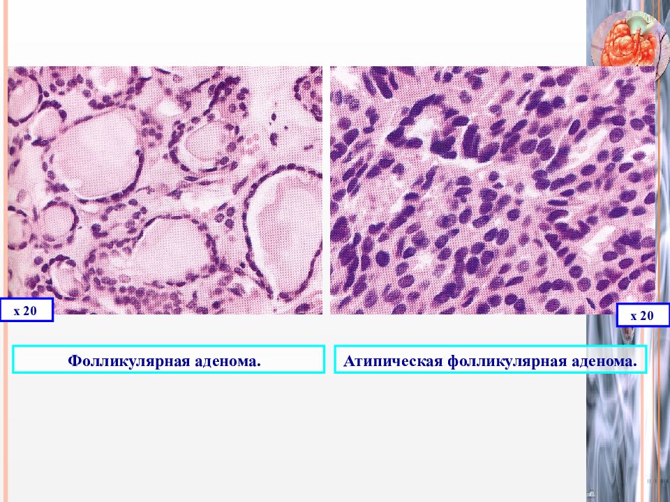 Железа аденома. Фолликулярная аденома гистология. Микрофолликулярная аденома. Аденома щитовидной железы гистология. Фолликулярная аденома щитовидной железы.