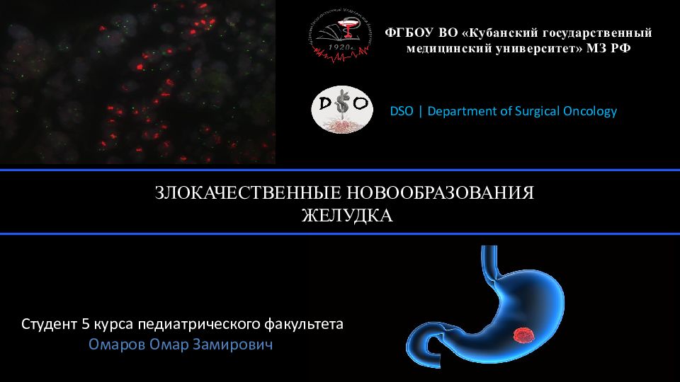 ЗЛОКАЧЕСТВЕННЫЕ НОВООБРАЗОВАНИЯ ЖЕЛУДКА DSO | Department of Surgical O