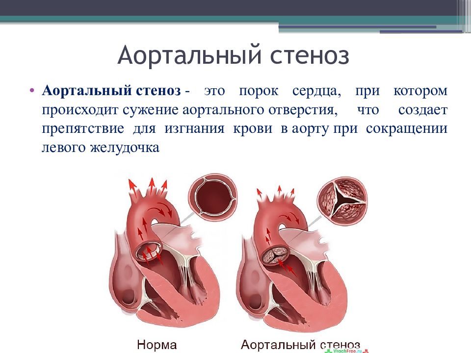 Стеноз аортального клапана. Порок аортального клапана сердца. Аортальный стеноз рекомендации 2020. Аортальный порок сердца стеноз. Порок сердца стеноз аортального клапана.