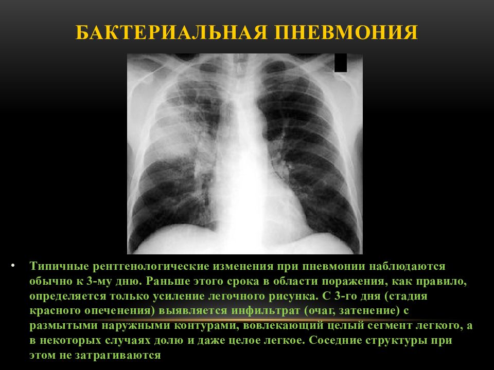 Чем отличается пневмония от ковида 19. Бактериальная пневмония снимок. Бактериальная пневмония на кт лёгких. Пневмония бактериальная компьютерная томография. Рентген при бактериальной пневмонии.