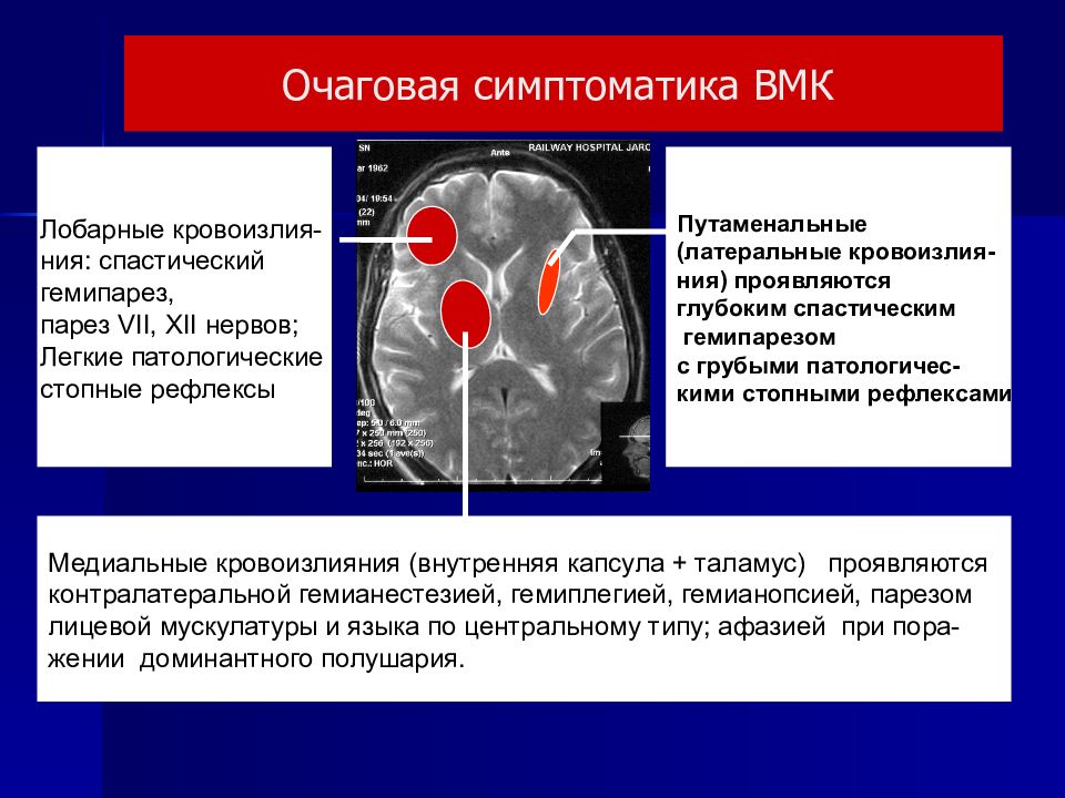 Инсульты презентация по неврологии