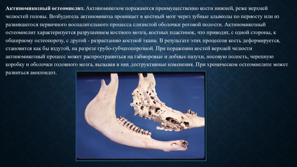 Воспаление костного мозга сустава. Костный мозг нижней челюсти. Актиномикоз костей челюсти. Остеомиелит кости нижней челюсти. Актиномикоз костей и суставов.