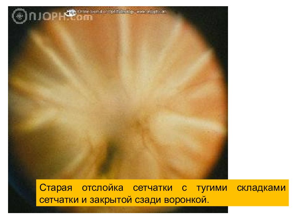 Презентация на тему отслойка сетчатки