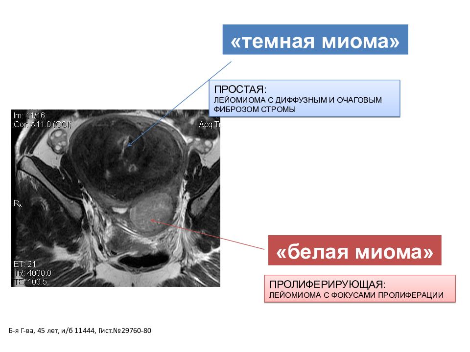 Миома матки мрт картина