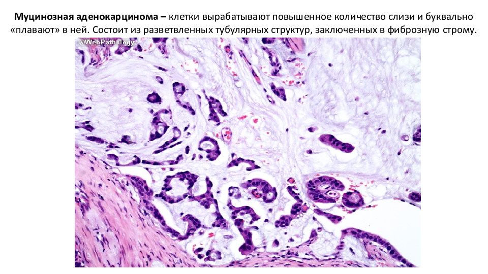 Аденокарцинома морфология