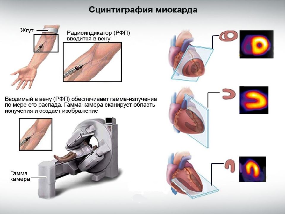 Презентация сцинтиграфия миокарда