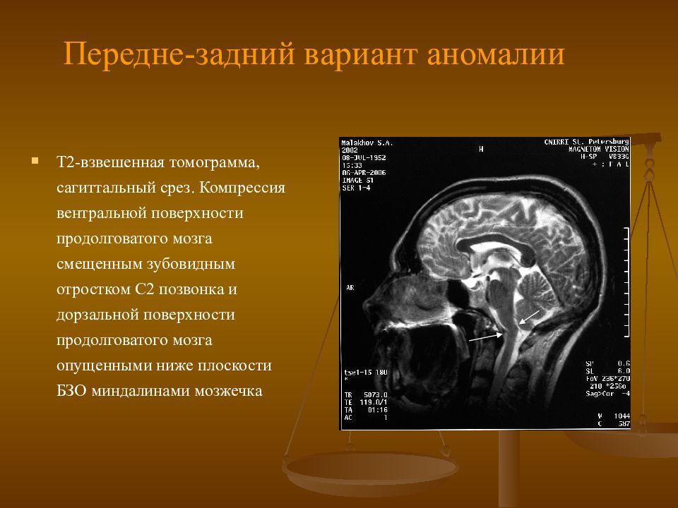 Мозжечок на уровне бзо. Пролабация миндалин мозжечка. Дислокация ствола головного мозга. Мозжечок на уровне бзо. Клиника вклинения ствола головного мозга.