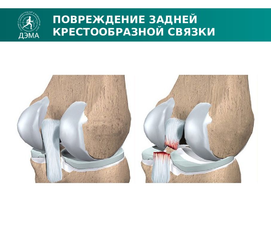 Степени повреждения задней крестообразной связки. Разрыв задней крестообразной связки. Разрыв задней крестообразной связки коленного сустава мрт. Степени повреждения задней крестообразной связки. Задняя крестообразная связка.