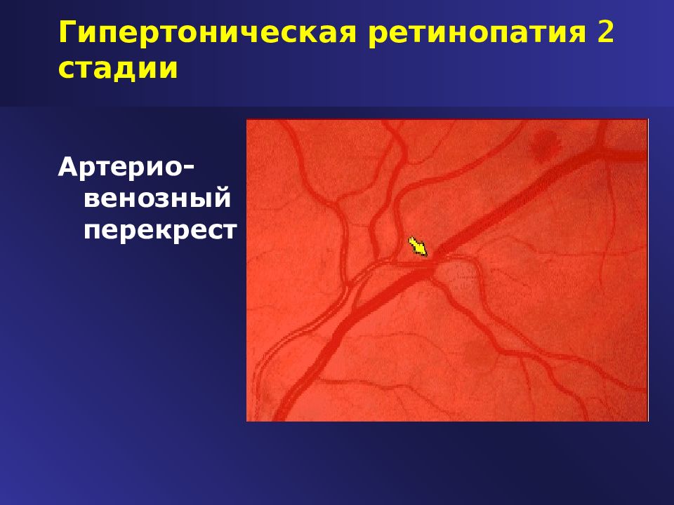 Гипертоническая ретинопатия стадии и клиническая картина