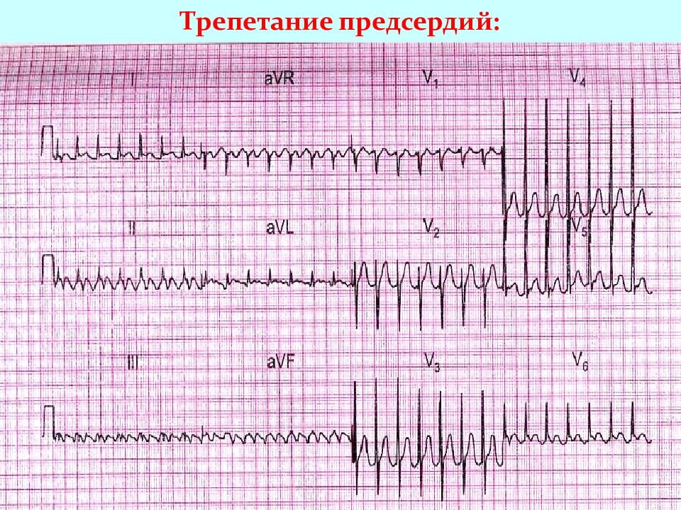 Экг при нарушениях ритма и проводимости презентация