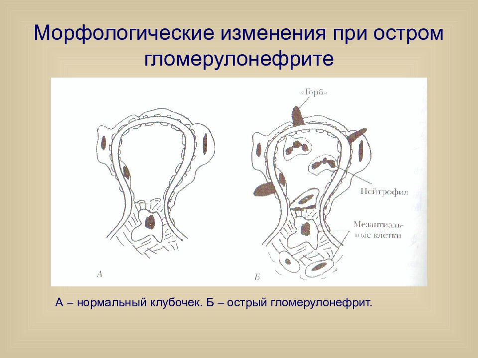 Морфологическая картина гломерулонефрита