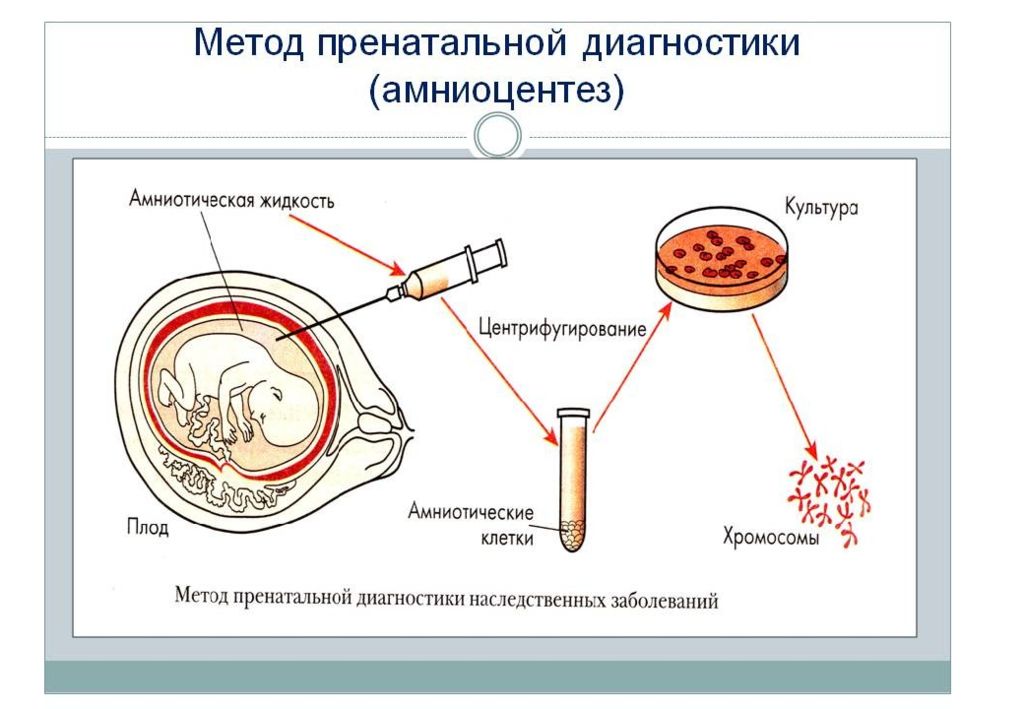 Пренатальная диагностика картинки