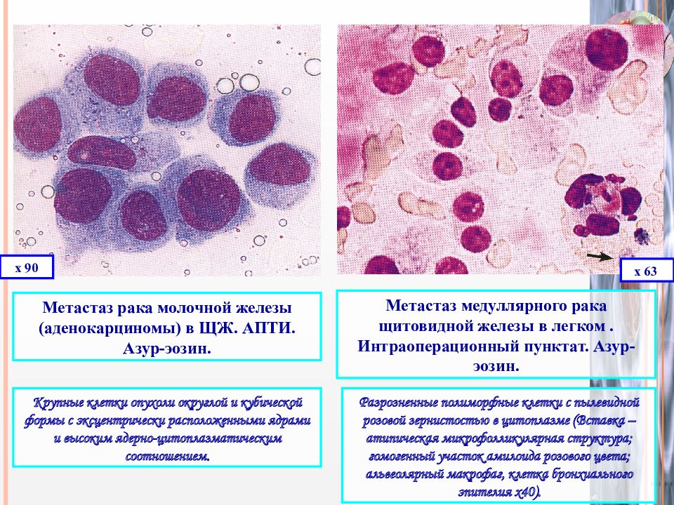 Рак молочных желез метастазы. Цитологическое исследование опухоли. Клетки щитовидной железы цитология. Медуллярная карцинома цитология. Цитологическое (гистологическое) исследование молочных желез.