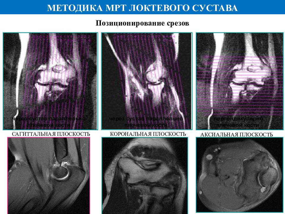 Мрт локтя. Сагиттальная проекция мрт. Анатомия локтевого сустава мрт. Локтевой сустав Сагиттальный срез на мрт. Мышцы локтевого сустава мрт.