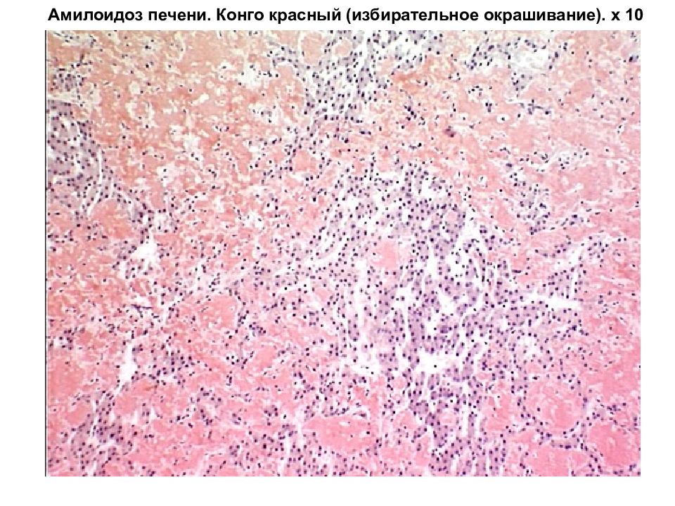 Амилоидоз печени презентация